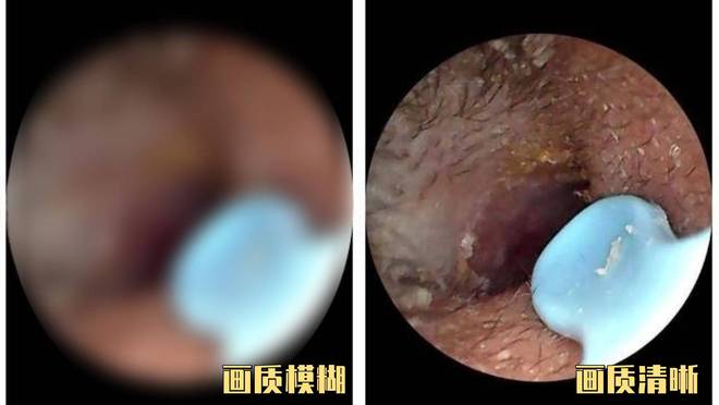 带摄像头的挖耳勺好用吗?挖耳勺到底怎么选?十大品牌测评分享!(图4)