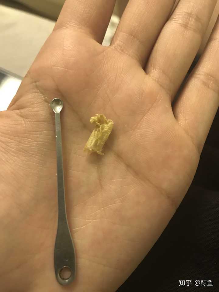 耳屎多影响听力吗